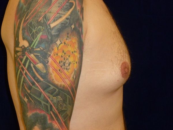 before gynecomastia right side view male patient case 3265