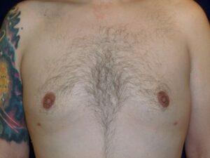 after gynecomastia front view male patient case 3265