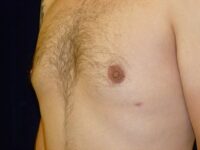 after gynecomastia left angle view male patient case 3265