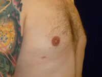 after gynecomastia right angle view male patient case 3265