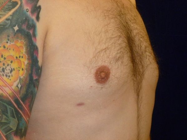 after gynecomastia right angle view male patient case 3265