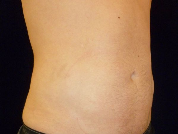 after liposuction right angle view male patient case 3278