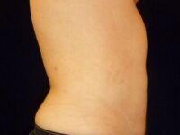 after liposuction right side view male patient case 3278