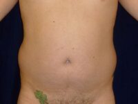 before liposuction front view male patient case 3278