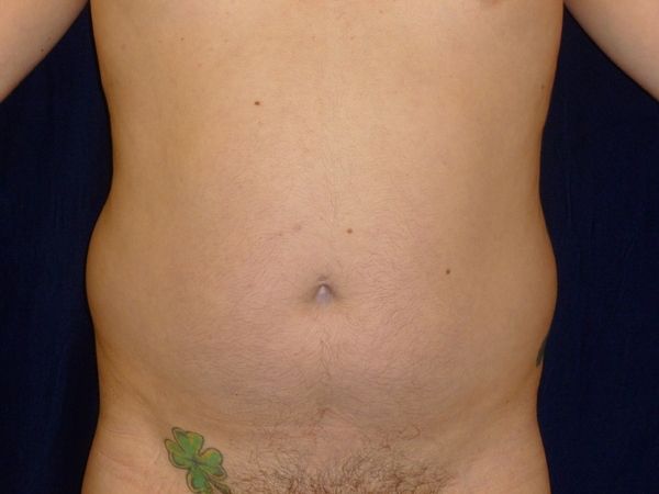 before liposuction front view male patient case 3278