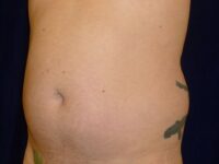 before liposuction left angle view male patient case 3278