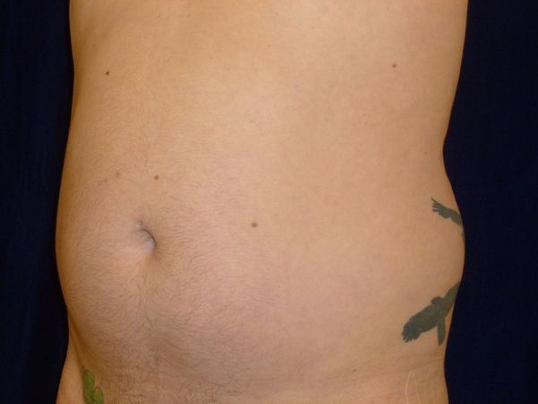 before liposuction left angle view male patient case 3278