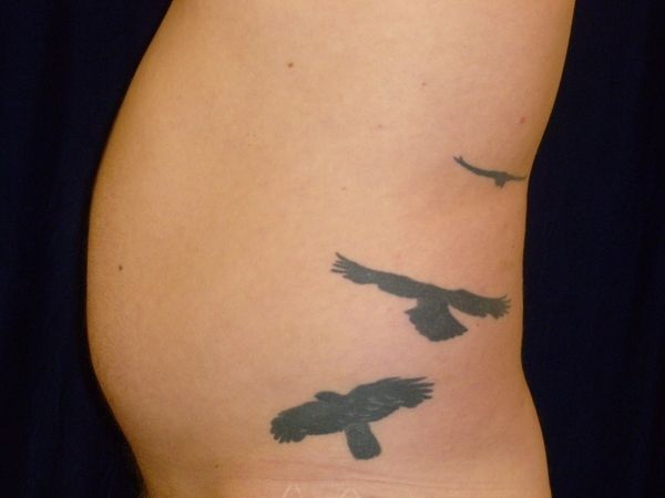 before liposuction left side view male patient case 3278
