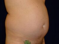 before liposuction right angle view male patient case 3278