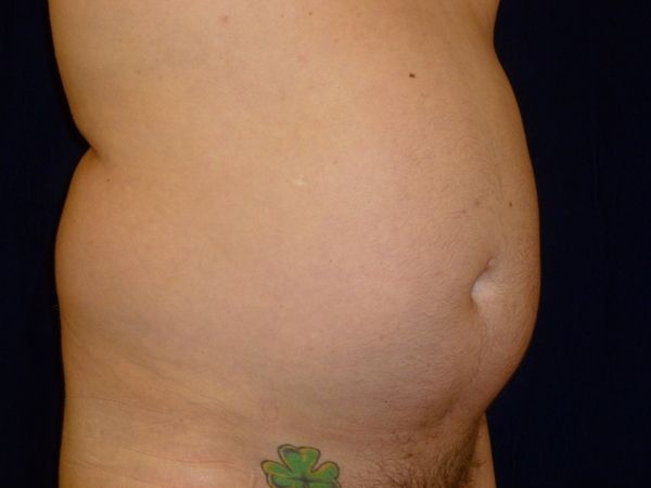 before liposuction right angle view male patient case 3278