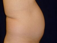 before liposuction right side view male patient case 3278