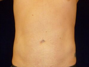 after liposuction front view male patient case 3278