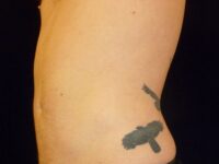 after liposuction left side view male patient case 3278