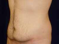 before tummy tuck left angle view male patient case 3398