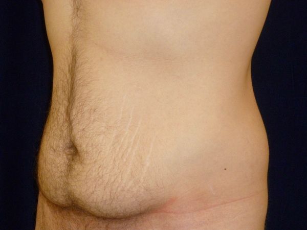 before tummy tuck left angle view male patient case 3398