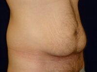 before tummy tuck right angle view male patient case 3398