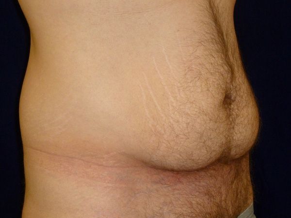 before tummy tuck right angle view male patient case 3398