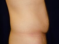 before tummy tuck right view male patient case 3398