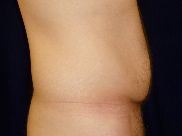 before tummy tuck right view male patient case 3398