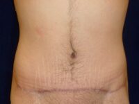 after tummy tuck front view male patient case 3398