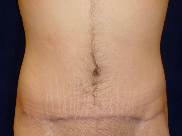 after tummy tuck front view male patient case 3398