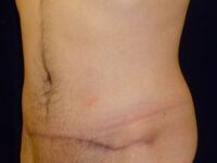 after tummy tuck left angle view male patient case 3398