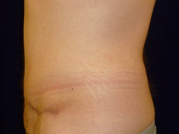 after tummy tuck left view male patient case 3398