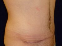 after tummy tuck right angle view male patient case 3398