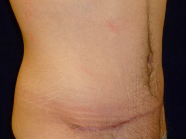 after tummy tuck right angle view male patient case 3398