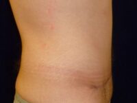 after tummy tuck right view male patient case 3398