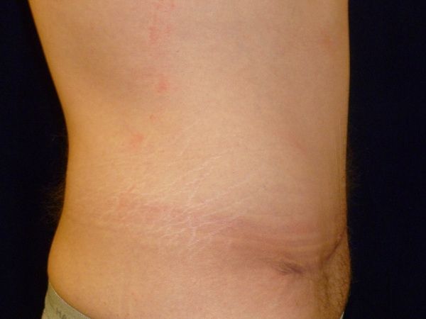 after tummy tuck right view male patient case 3398