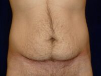 before tummy tuck front view male patient case 3398
