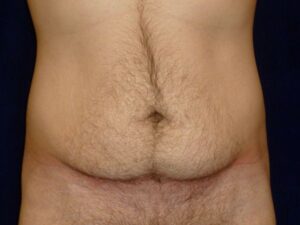 before tummy tuck front view male patient case 3398