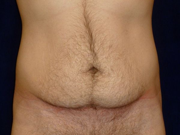 before tummy tuck front view male patient case 3398
