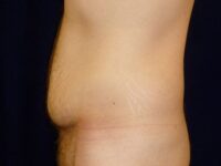 before tummy tuck left view male patient case 3398