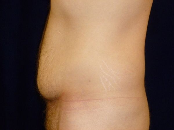 before tummy tuck left view male patient case 3398