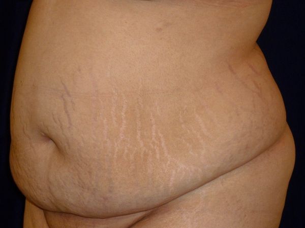 before tummy tuck left angle view female patient case 3409