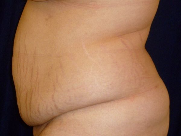before tummy tuck left view female patient case 3409