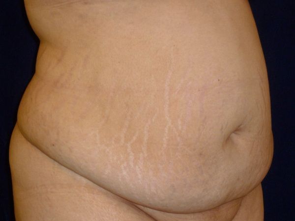 before tummy tuck right angle view female patient case 3409