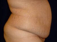 before tummy tuck right view female patient case 3409