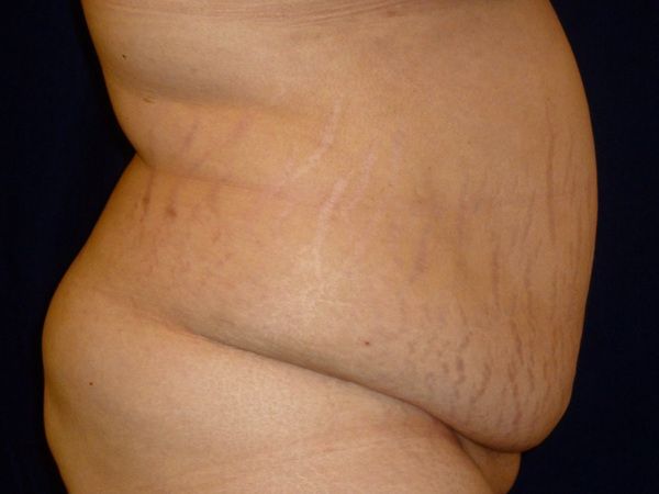 before tummy tuck right view female patient case 3409