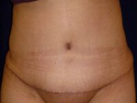 after tummy tuck front view female patient case 3409