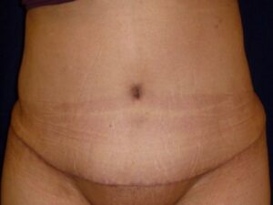 after tummy tuck front view female patient case 3409