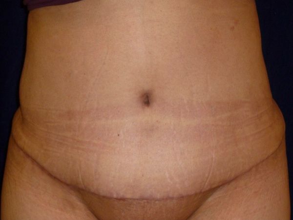 after tummy tuck front view female patient case 3409
