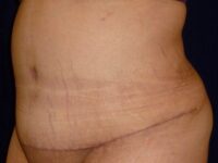 after tummy tuck left angle view female patient case 3409