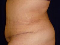 after tummy tuck left view female patient case 3409