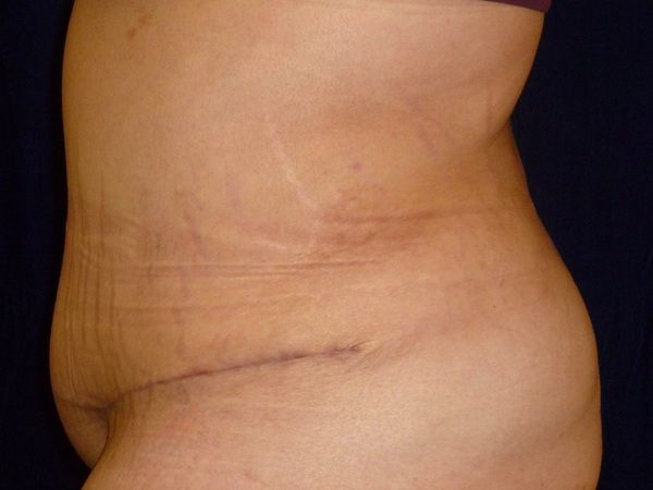 after tummy tuck left view female patient case 3409