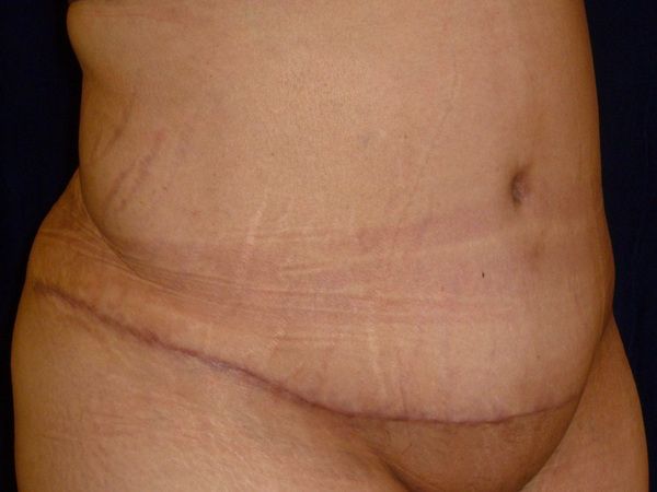 after tummy tuck right angle view female patient case 3409