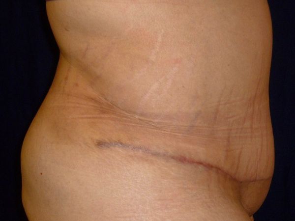 after tummy tuck right view female patient case 3409