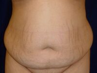 before tummy tuck front view female patient case 3409